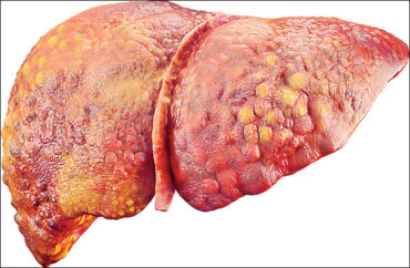 Liver: Beware of the liver!